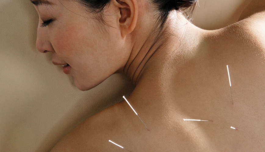 Acupuncture Therapy
