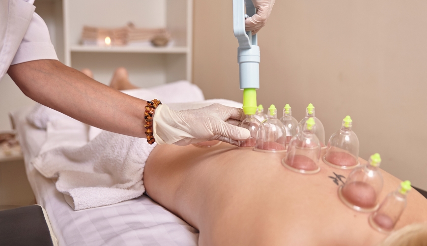 Cupping Therapy