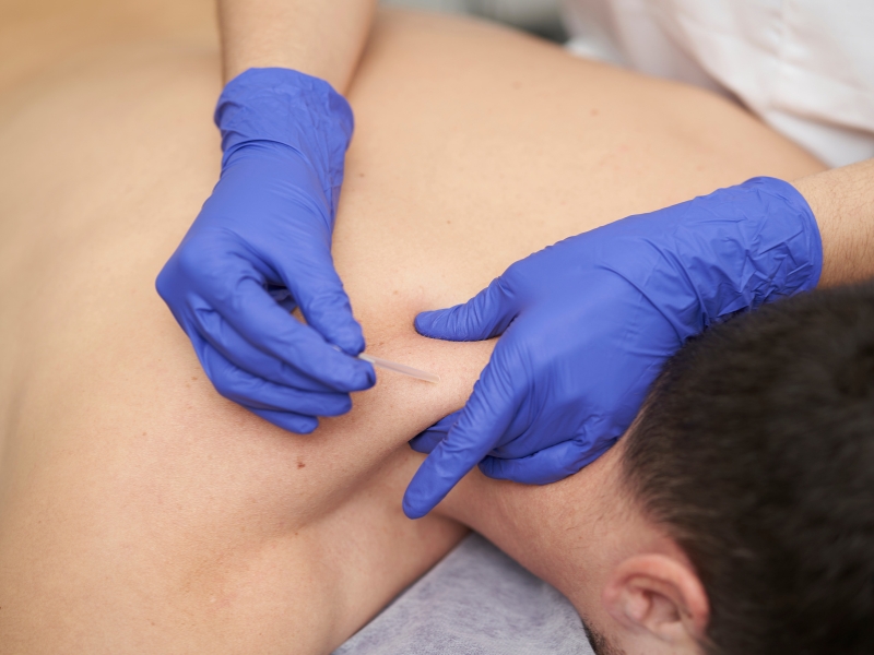 Dry Needling Therapy