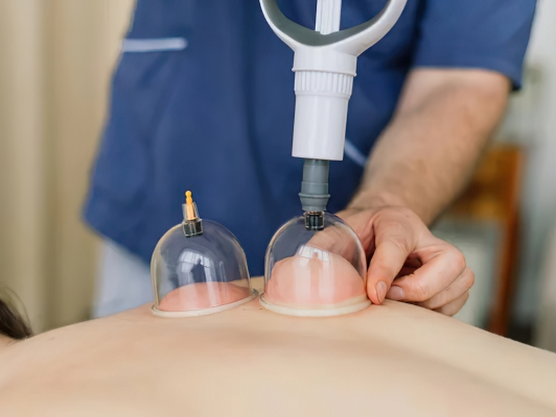 Cupping Therapy