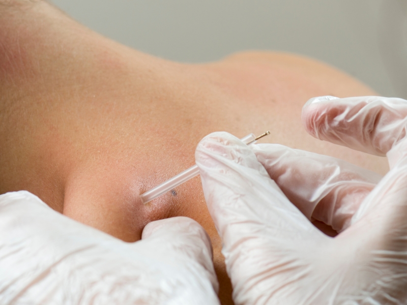 Dry Needling Therapy