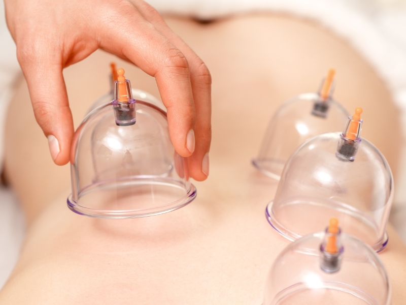 Cupping Therapy